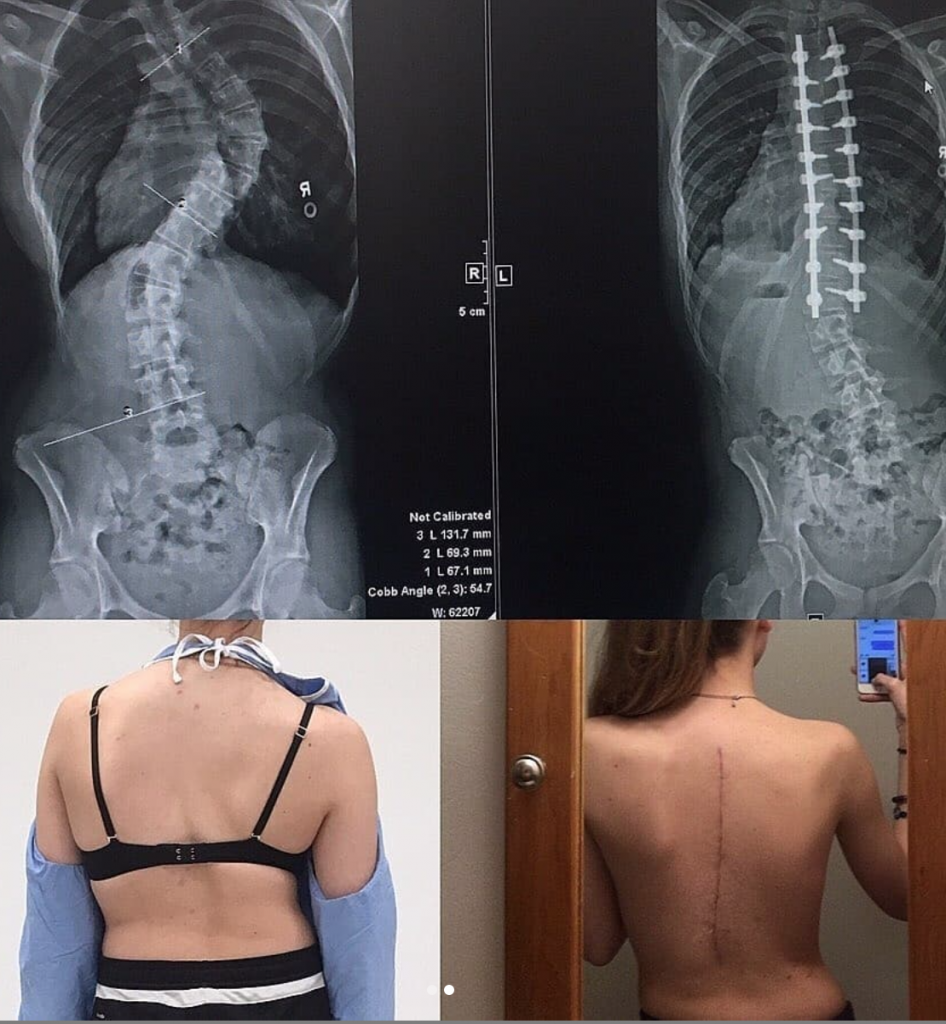 What To Do When Your Back Hurts From Scoliosis