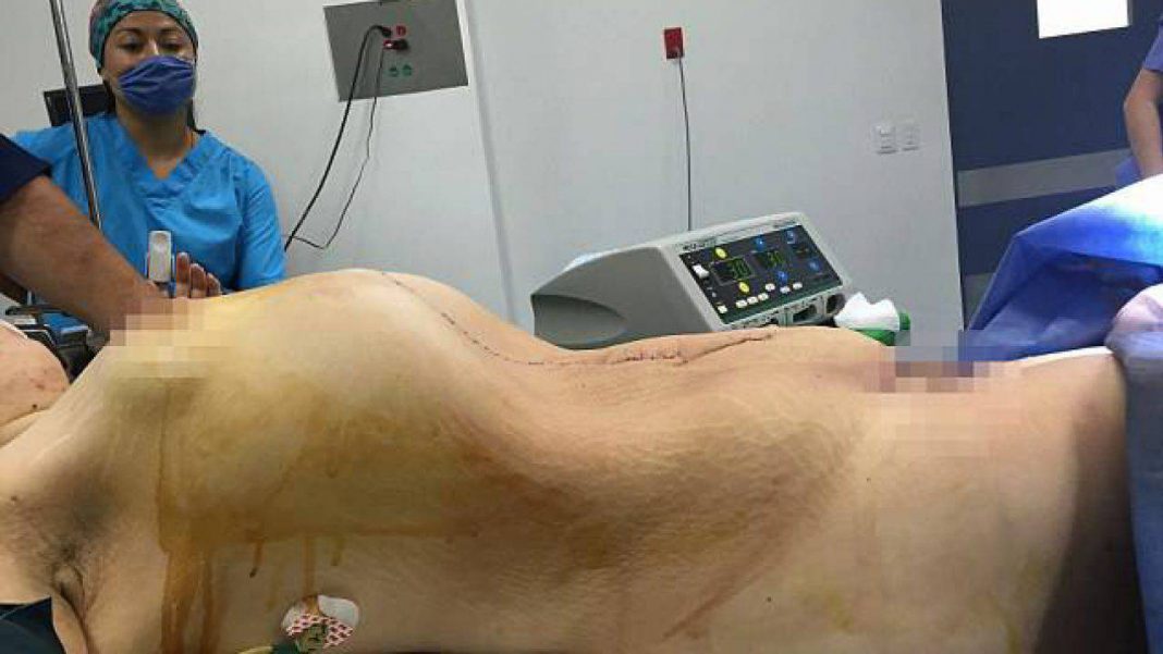 Ovarian cyst classification image