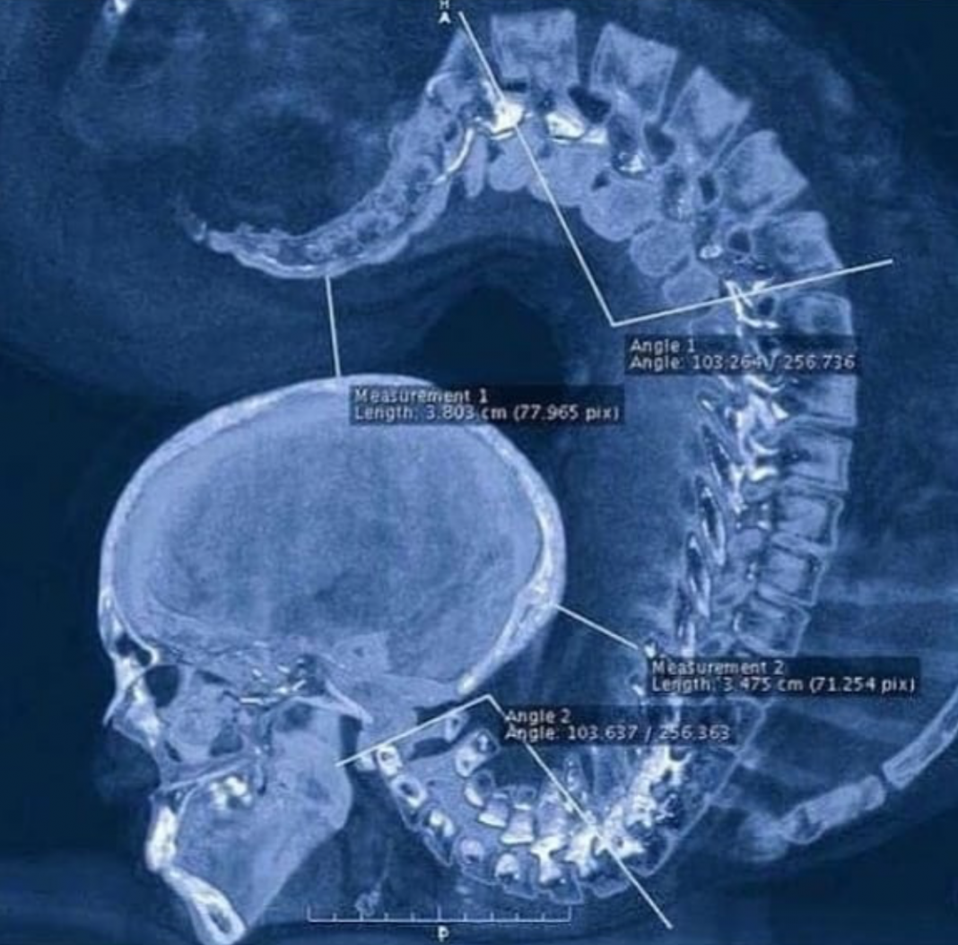 Xray of an individuala contortionist in an extreme pose of spinal extension! MEDizzy Journal