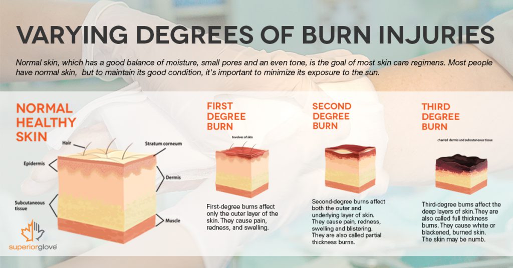 Image result for degree of burns