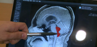 A Man Suffered Splitting Headaches For Years Caused By Tapeworm In His Brain