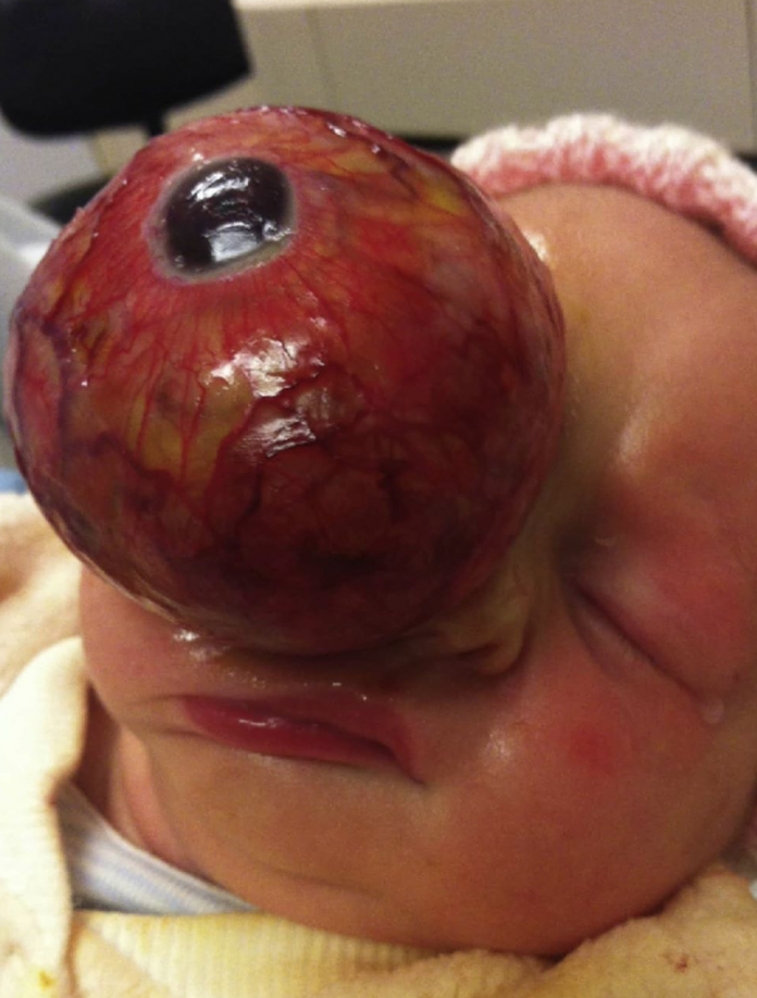 Newborn with giant teratoma