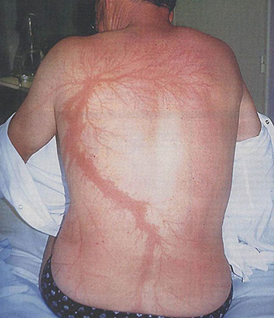 Lichtenberg Figures