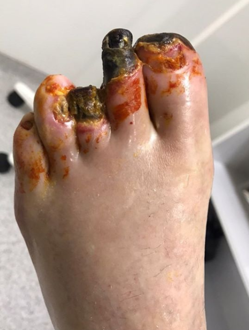 Foot gangrene