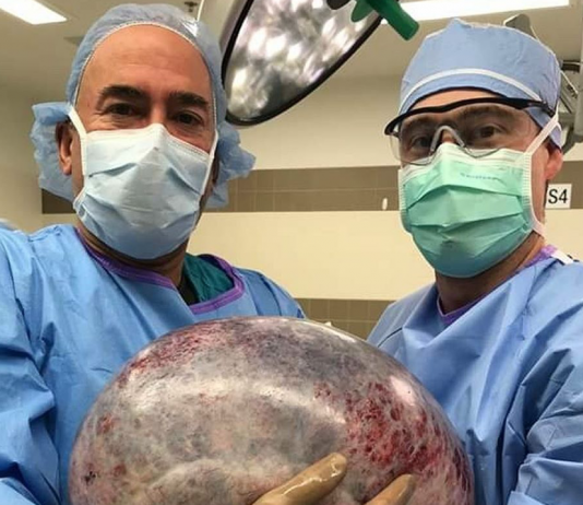An enormous 40 pound (18 kg) ovarian cyst