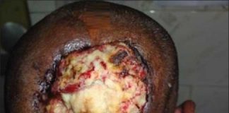 Marjolin’s ulcer:How bad can a scar become? Pre-operative (a) and per-operative. (b) Photograph showing the ulcerative growth as a result of Marjolin’s ulcer on the occiput of the scalp