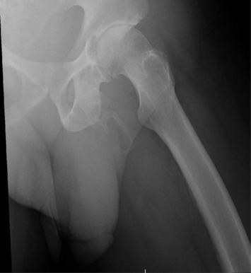 Penile ossification: Extensive plaque-like calcification along the expected distribution of the penis.