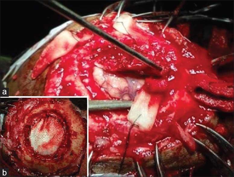 Intra-perative photograph of Marjolin's ulcer showing (a) the eroded skull bone with exposed underlying brain and (b) the repaired dural defect using G-dura patch