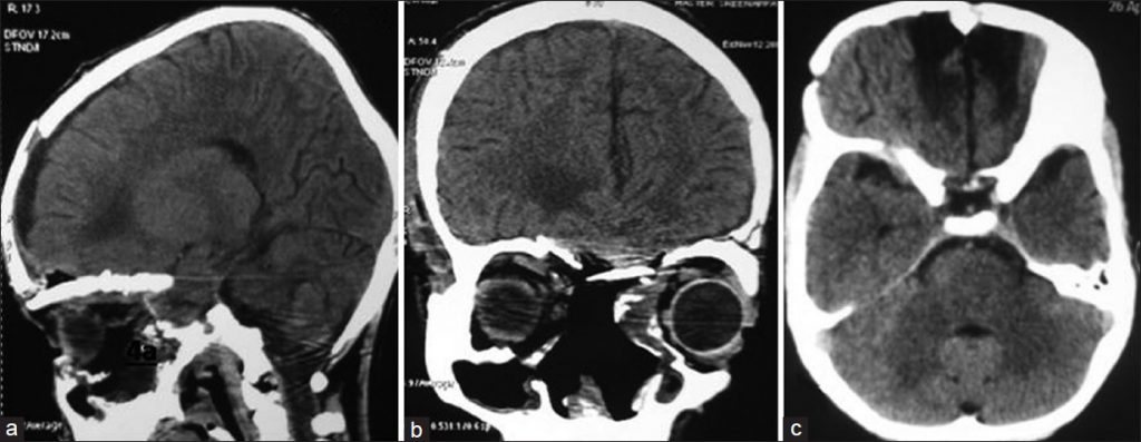 Ewing's sarcoma: CT brain contrast study