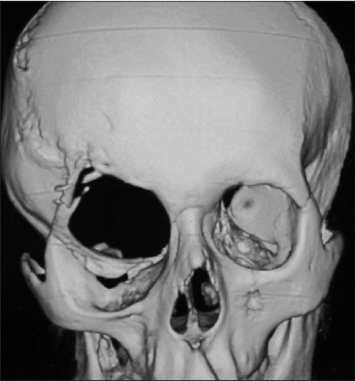 CT scan showing dysplastic greater wing of sphenoid on right side of eye orbit with herniation of temporal lobe.