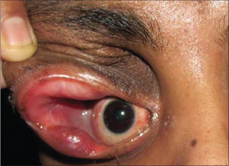 Patient showing post-operative view after complete excision of encephalocele with redundant eyelid