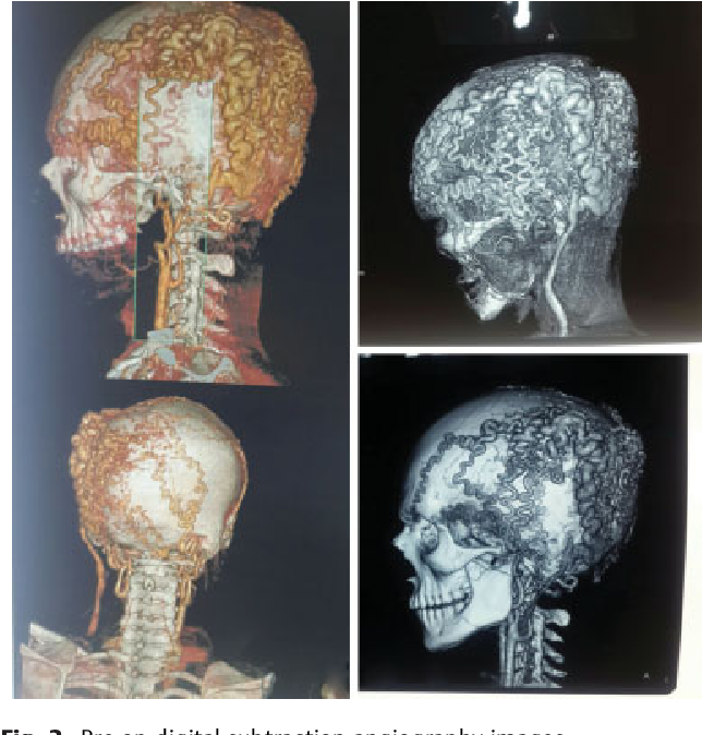 Cirsoid aneurysm: Pre-op digital subtraction angiography images.