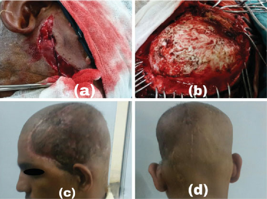 Cirsoid aneurysm: Intra-op photograph before ligation of feeding arteries (a) and after en block excision of the lesion (b). Post-op photographs of the patient 2 months after surgery (c, d).