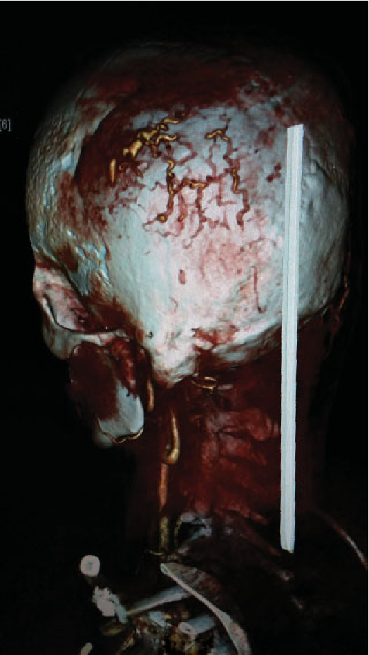 Circoid aneurysm: No recurrence 6 months after surgery.