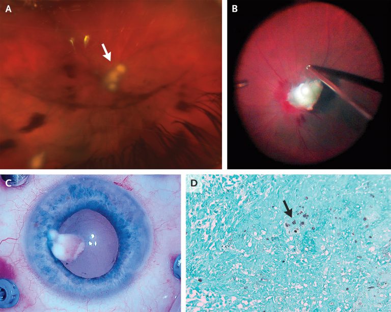 Decreased Vision Due to Fungus in an IV Drug User MEDizzy Journal
