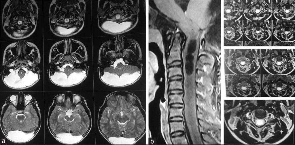 Growing skull fracture: MRI