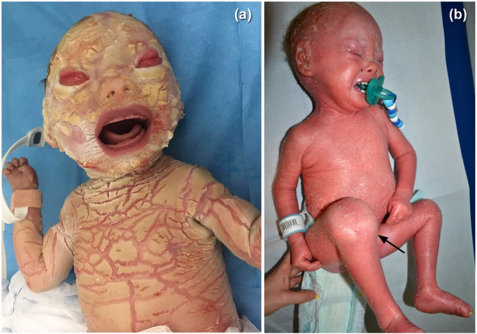 Harlequin Ichthyosis Example