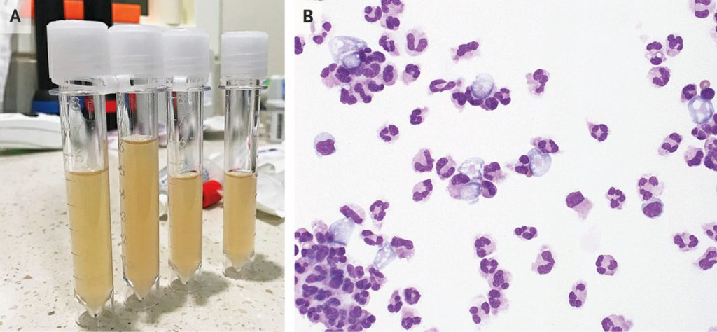 can-swimming-expose-to-naegleria-fowleri-the-brain-eating-amoeba