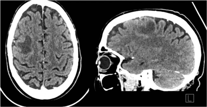 brain-abscess-secondary-to-tooth-infection-medizzy-journal