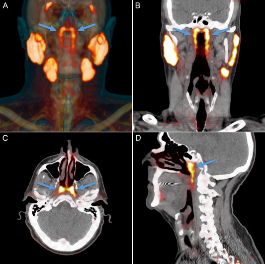 Overview of the new organ as shown on the PSMA PET/CT scan. 