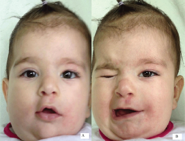 A Baby With Asymmetrical Face On Crying!