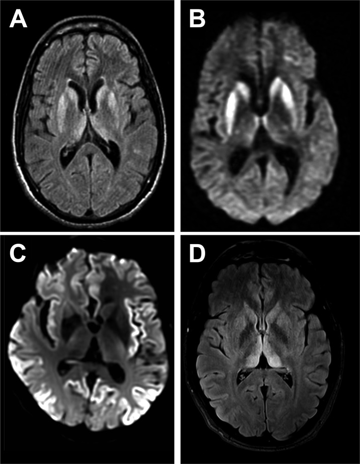 MRI of Sporadic Creutzfeldt–Jakob disease.