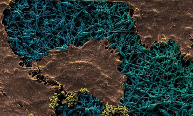 Diamond silk fibres of wound dressing shown in bluish green colour, with the golden-brown colour representing the skin cell growth on the membrane. 