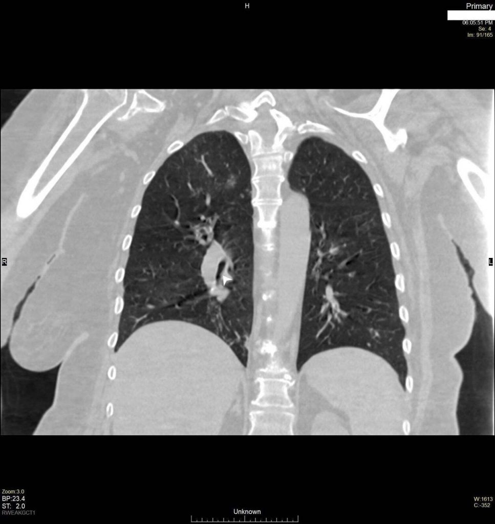 CT Scan of patient's lungs showing slight narrowing of the bronchus at the level of stuck swab.