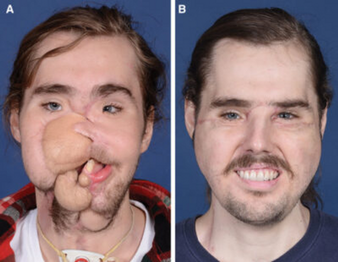 Face Transplant Before and Aftetr