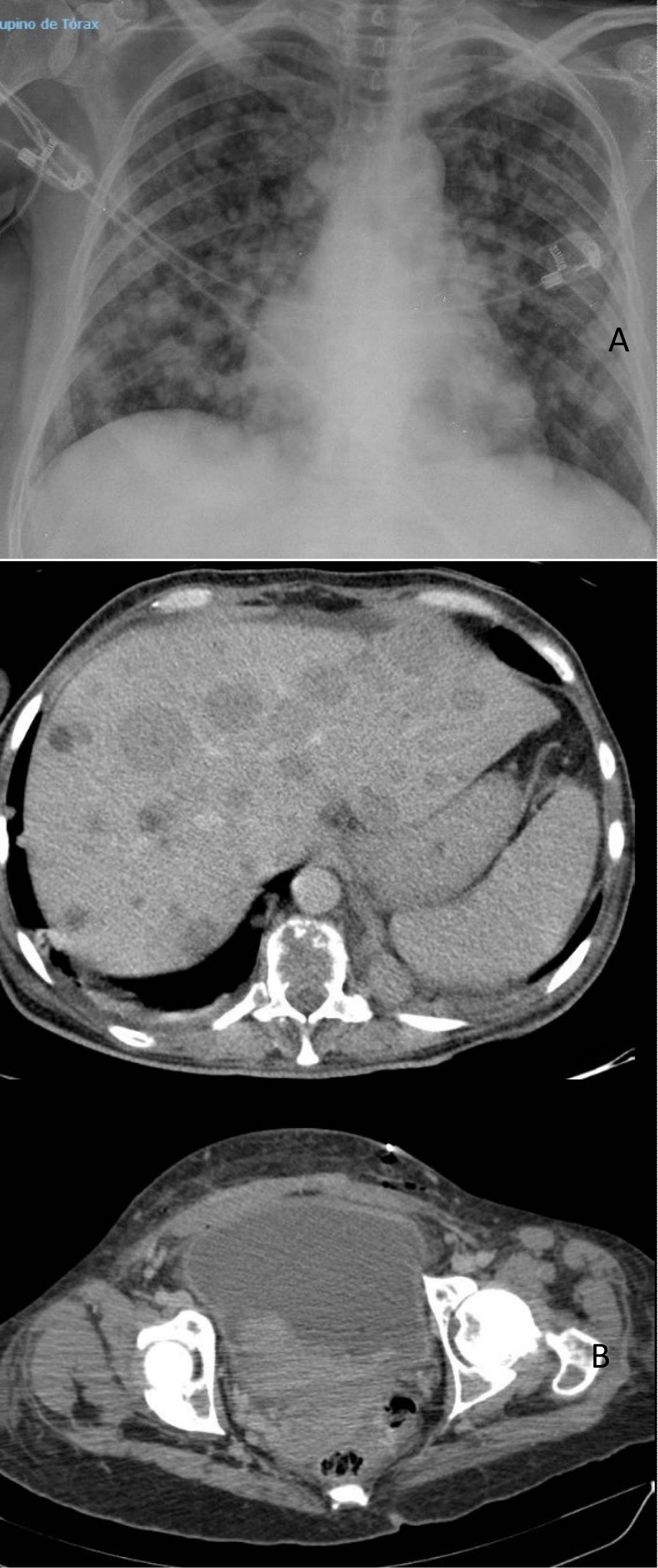 Metastatic Bladder Melanoma At Puerperium MEDizzy Journal