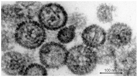 Electron Microscopy of Hantavirus that caused the infection in the German teen.