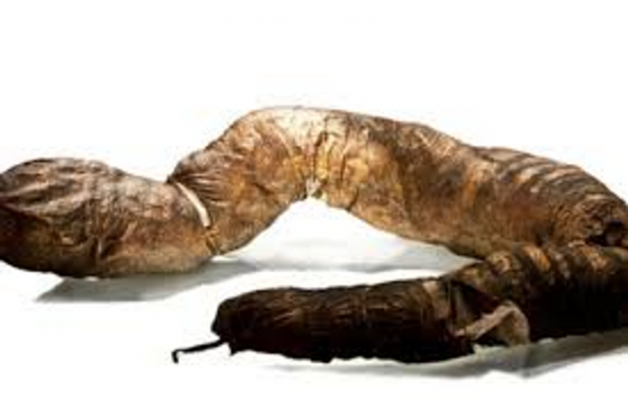 This 8-foot long giant megacolon came from the “Balloon Man,” an unfortunate fellow whose lifelong constipation stemmed from Hirschsprung’s disease. (Photo: Mütter Museum, CC BY-NC-SA 3.0)