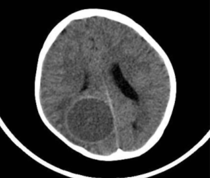 Brain hydatid cyst