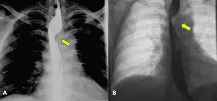 Dysphagia lusoria Dysphagia lusoria