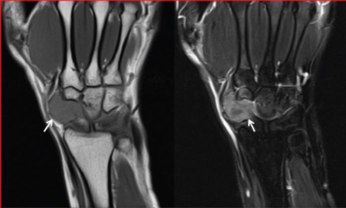 Giant cell tumour of tendon sheath