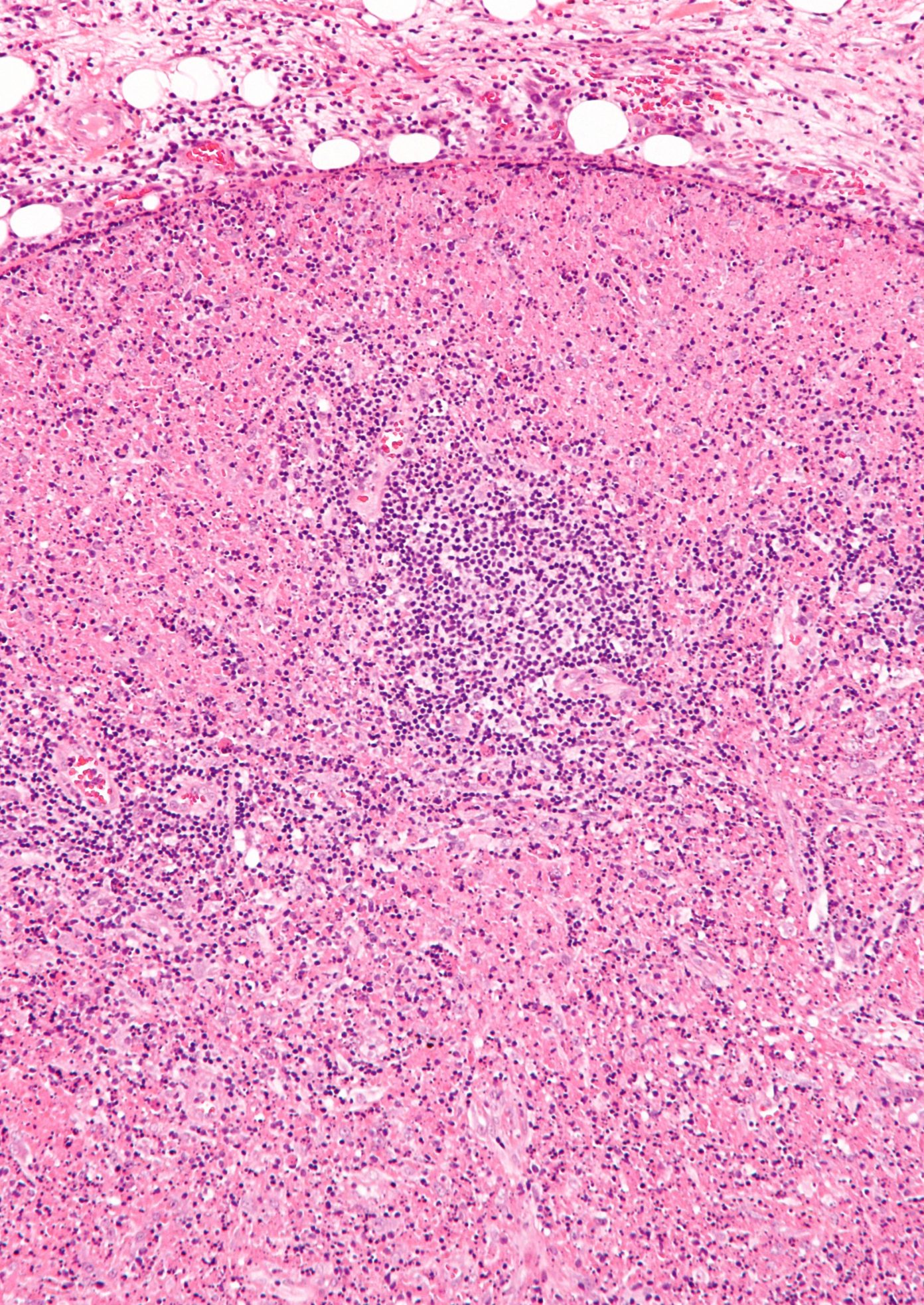 Kikuchi–Fujimoto Disease In 56-Year-Old Female Patient