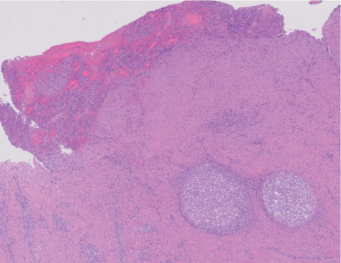 Necrotising granulomatosis sarcoidosis