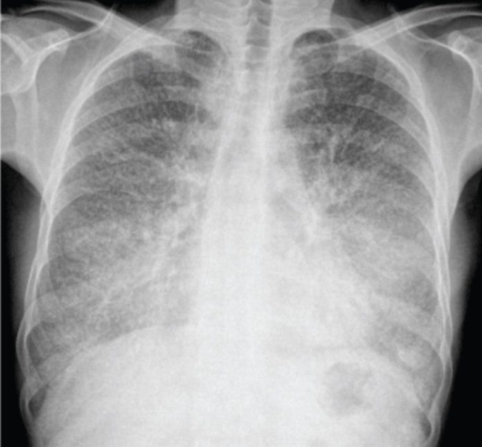 CXR of a patient with shortness of breath