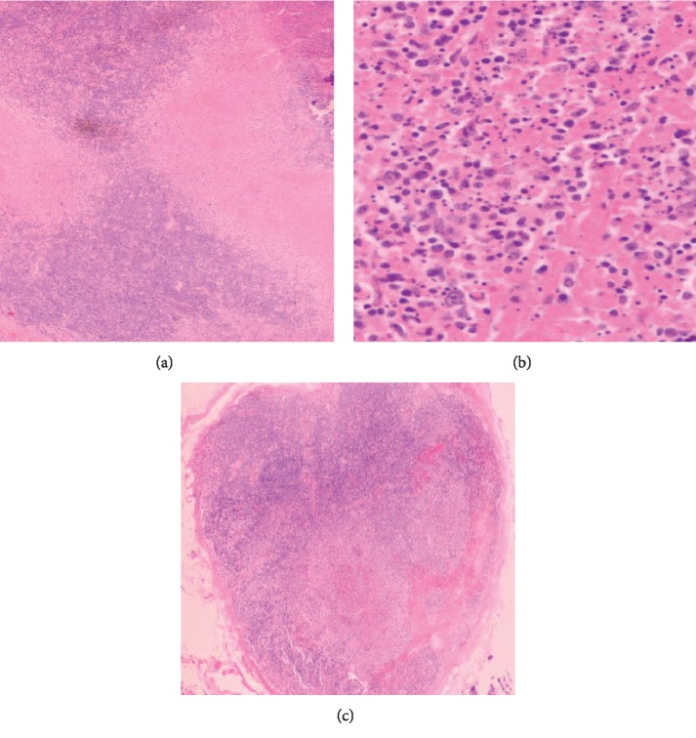 Kikuchi-Fujimoto Disease In 29-Year-Old Black African Patient