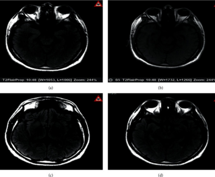 Encephalitis