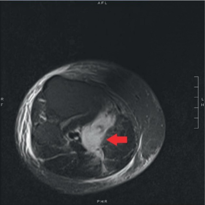 Baker's Cyst Rupture in an Inflammatory Bowel Disease Patient