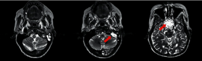 Metastatic Adenocarcinoma