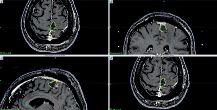 Single Solitary Fibrous Tumour