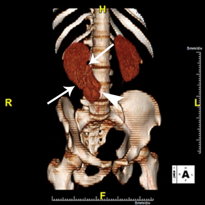 Triple Kidneys