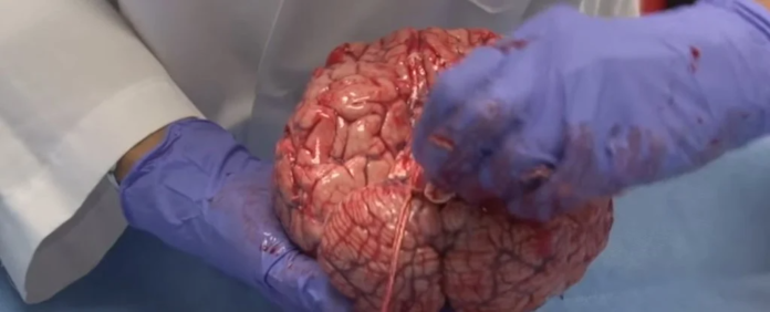 A Freshly Removed Human Brain