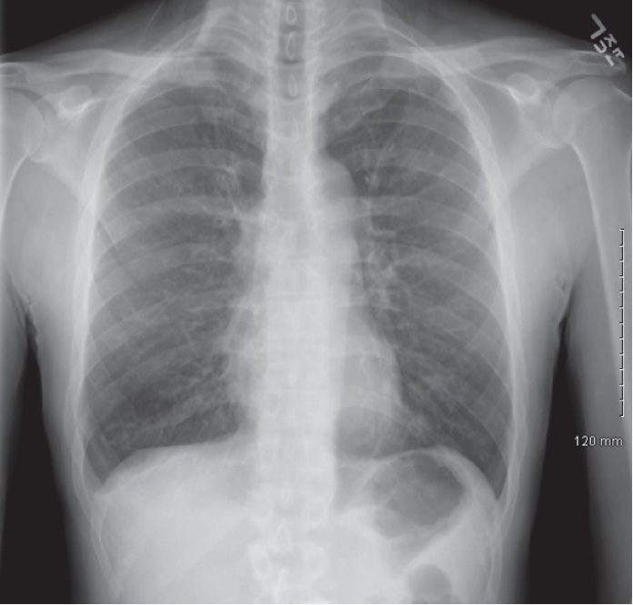 Allergic Bronchopulmonary Aspergillosis