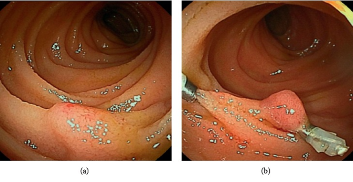 Arteriovenous malformations