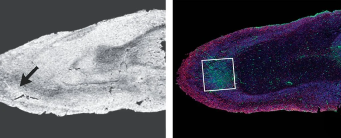 Autopsies of COVID-19 Patients Reveal Widespread Damage In Brain Tissues