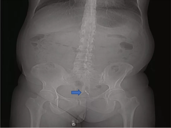 IUD Perforation Of The Bladder With Stone Formation   IUD Perforation 696x519 