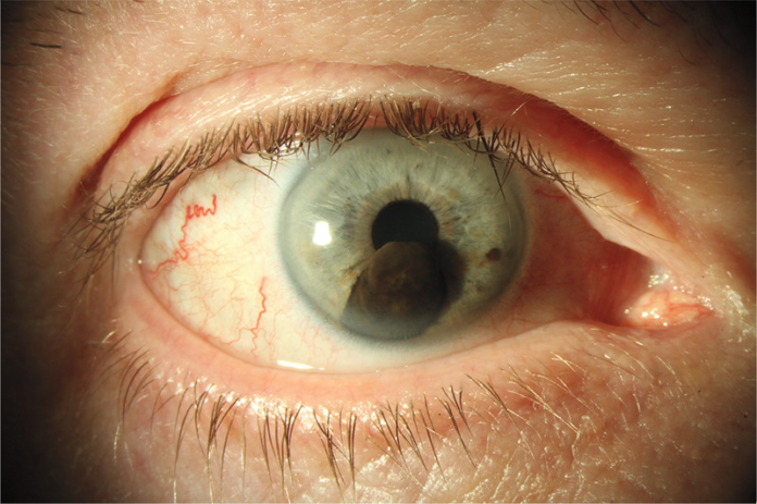 Iridociliary Melanoma With Secondary Glaucoma